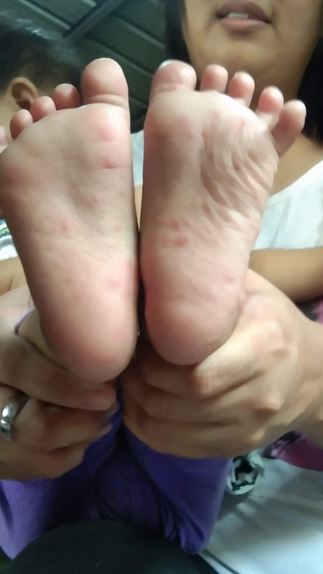 Hand foot mouth disease affects child less than 8 year old